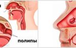 Безоперационные способы лечения полипов в носу