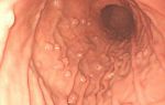 Симптомы и варианты лечения полипа желудка гиперпластического типа