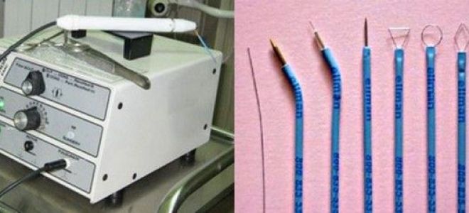 Как происходит удаление кондилом Сургитроном и чему уделить внимание после удаления
