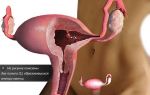 Признаки появления полипа эндометрия матки и как от него избавиться
