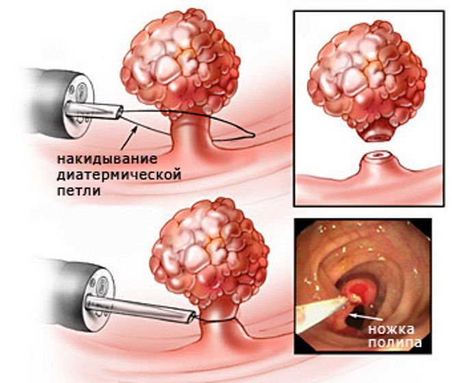 Удаление полипов желудка - Эндоскопия