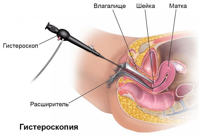 Гистероскопия матки
