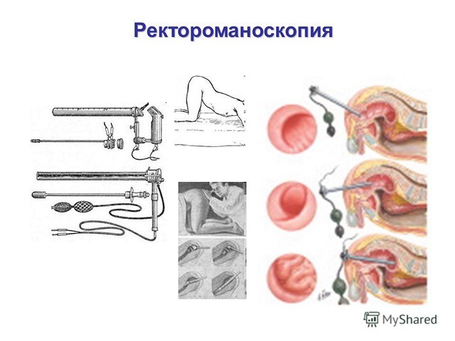 Ректороманоскопия